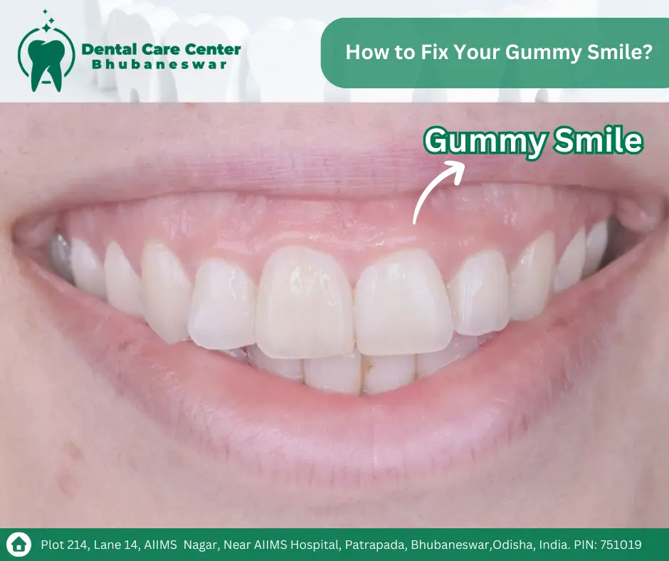 Boost Your Confidence with a Beautiful Smile: Discover How to Fix Your Gummy Smile Today